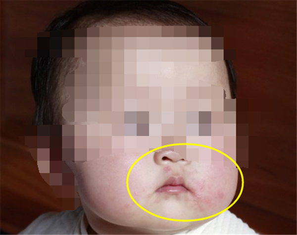 吃芒果過敏的癥狀圖片 吃芒果過敏了怎么辦